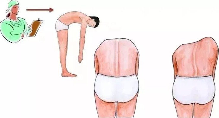 脊柱側(cè)彎早發(fā)現(xiàn)，早治療